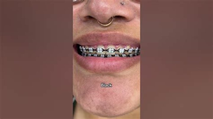Are black braces good?