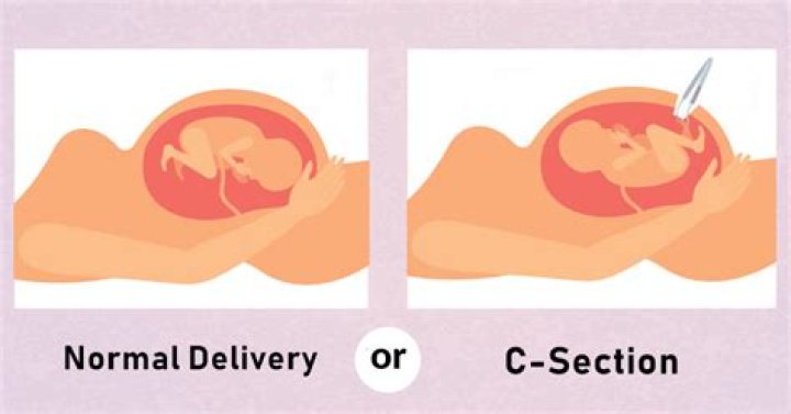 Are C-sections safer?
