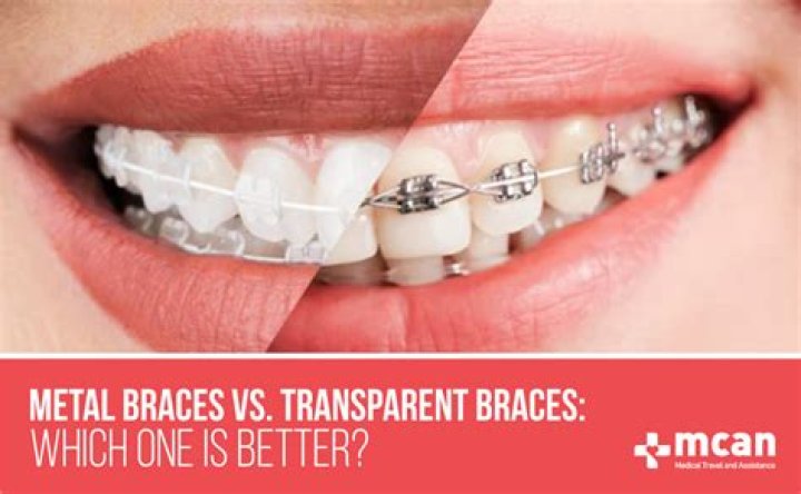 Are clear braces more expensive?