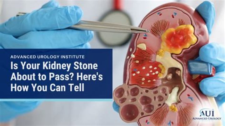 Are kidney stones soft when they come out?