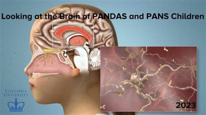 Are pans brain inflammation?