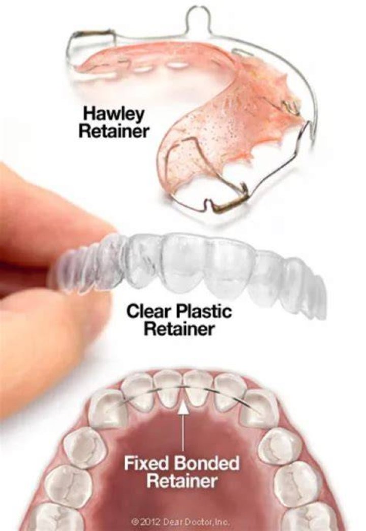 Are plastic or wire retainers better?
