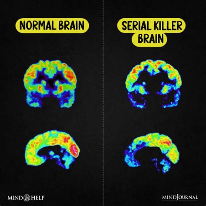 Are serial killers brains different?
