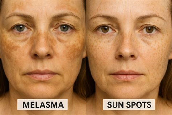 Are sun spots melasma?