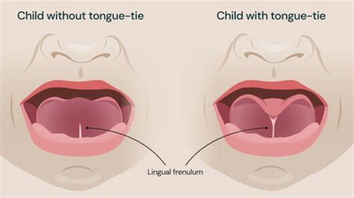 At what age can tongue-tie be corrected?