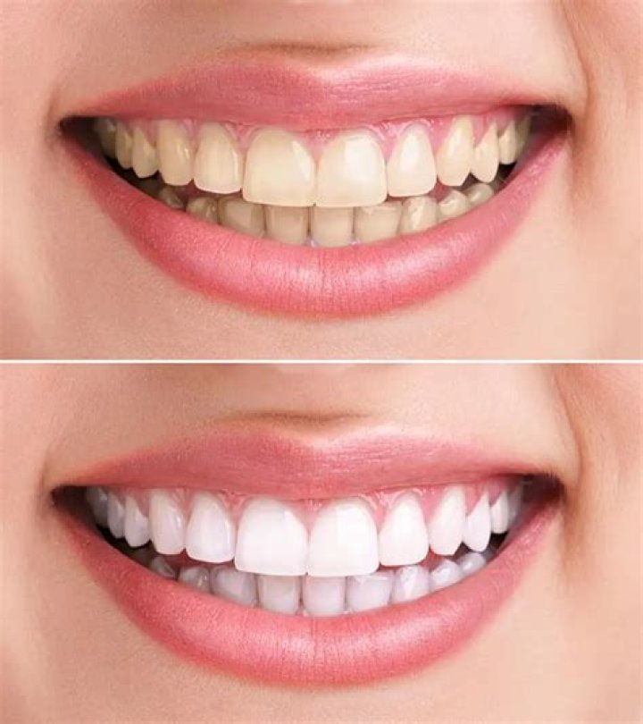 Can 13 year olds whiten their teeth?