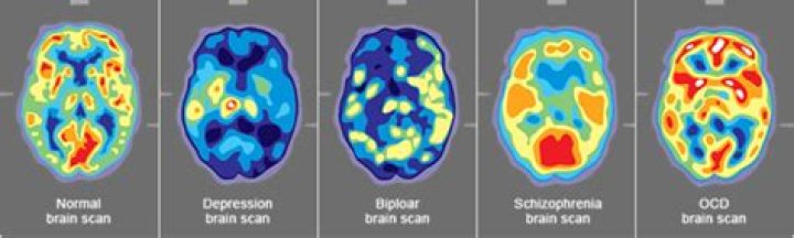 Can a brain scan show bipolar disorder?