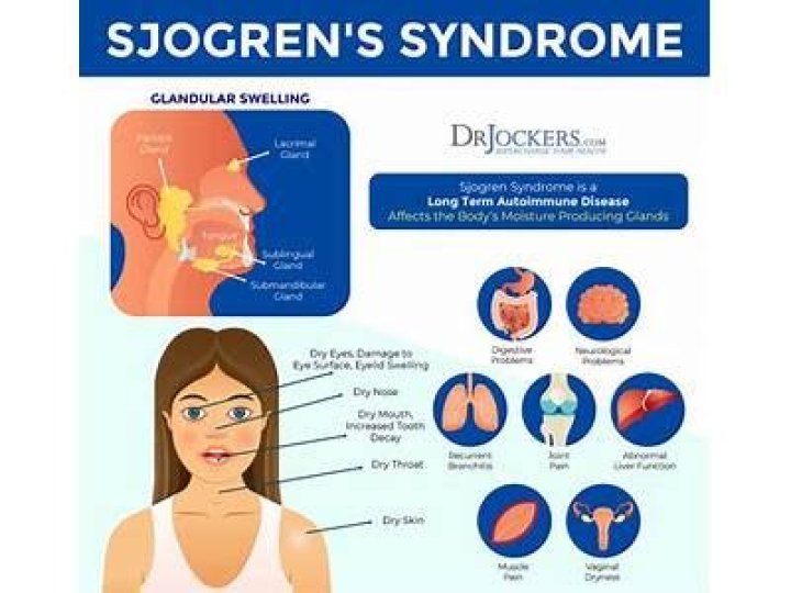 Can a dentist tell if you have sjogrens?