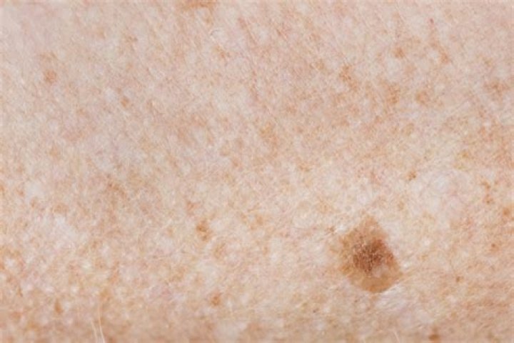 Can a freckle be melanoma?