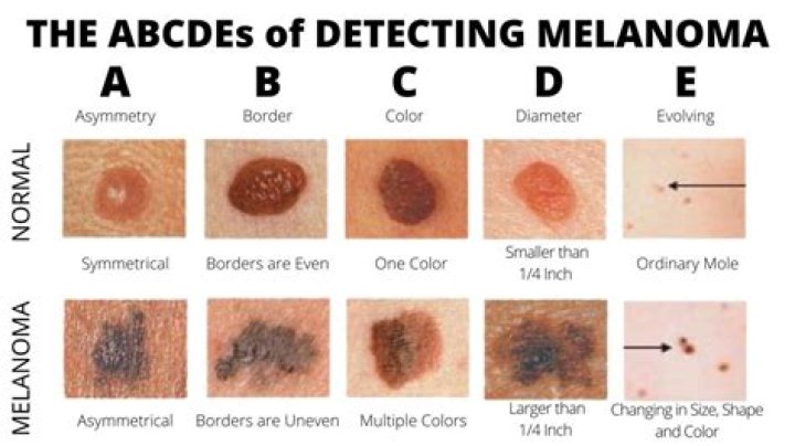 Can a freckle look like melanoma?