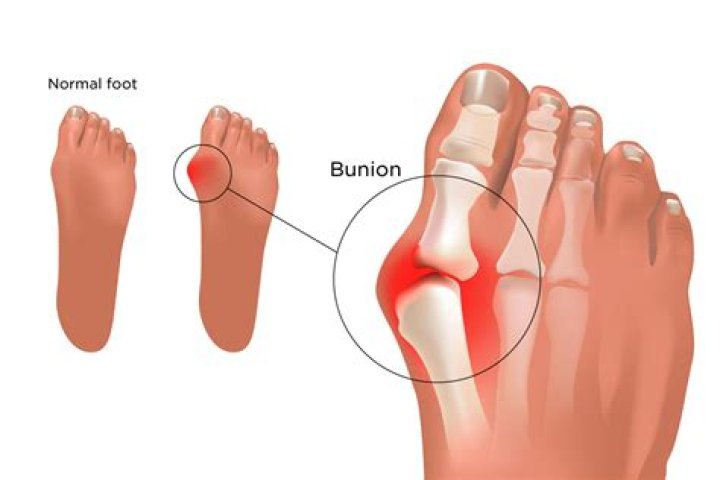 Can bunions cause infection?