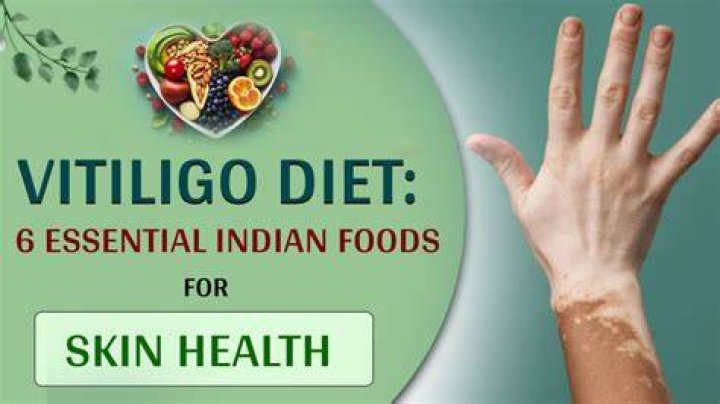 Can diet cure vitiligo?