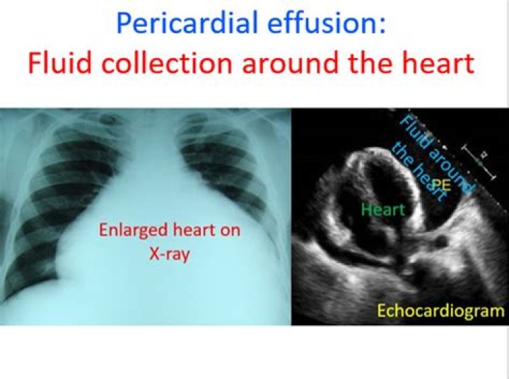 Can fluid around the heart go away on its own?