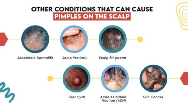 Can ginger cause pimples?