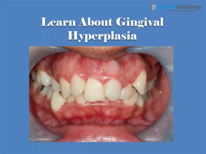 Can gingival hyperplasia go away?
