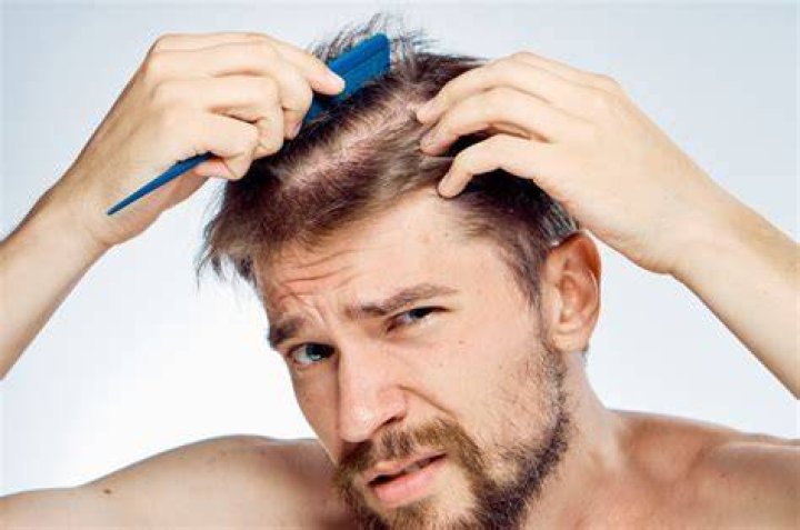 Can Hairfall be stopped?