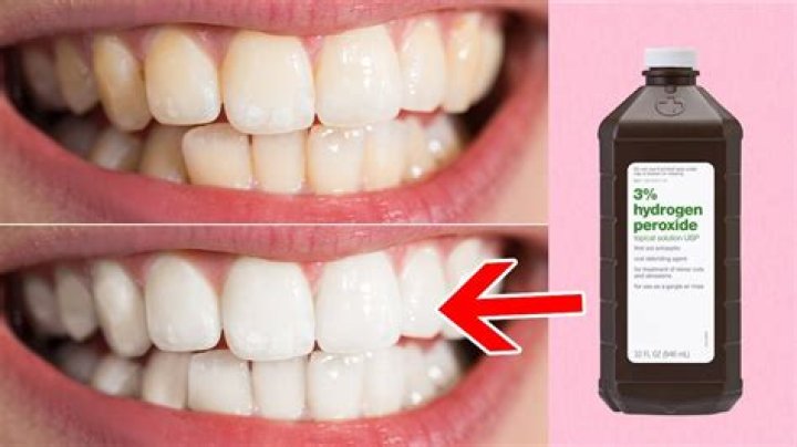 Can hydrogen peroxide damage veneers?