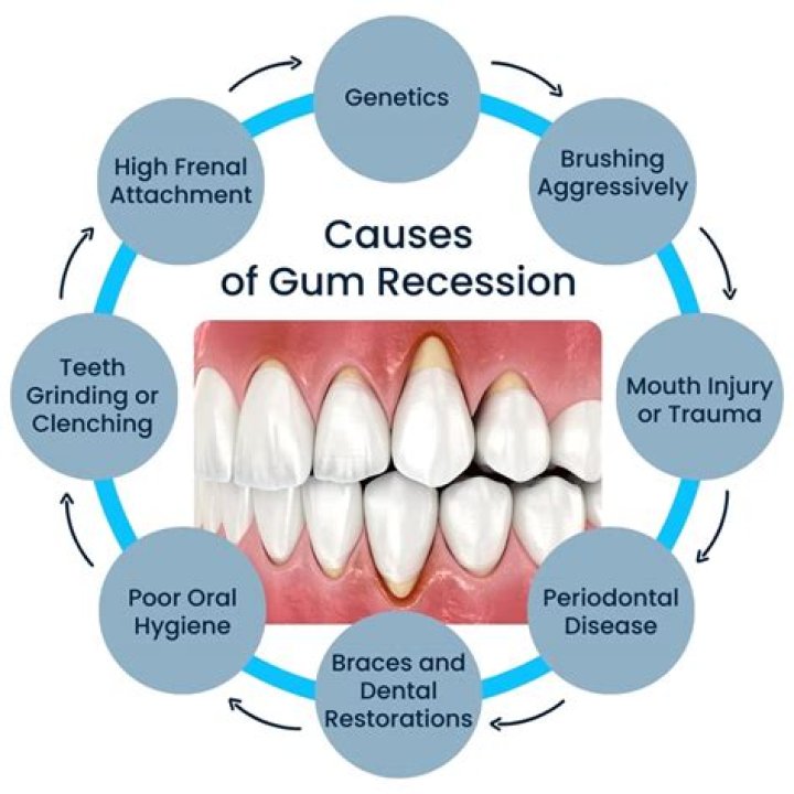 Can hydrogen peroxide reverse receding gums?
