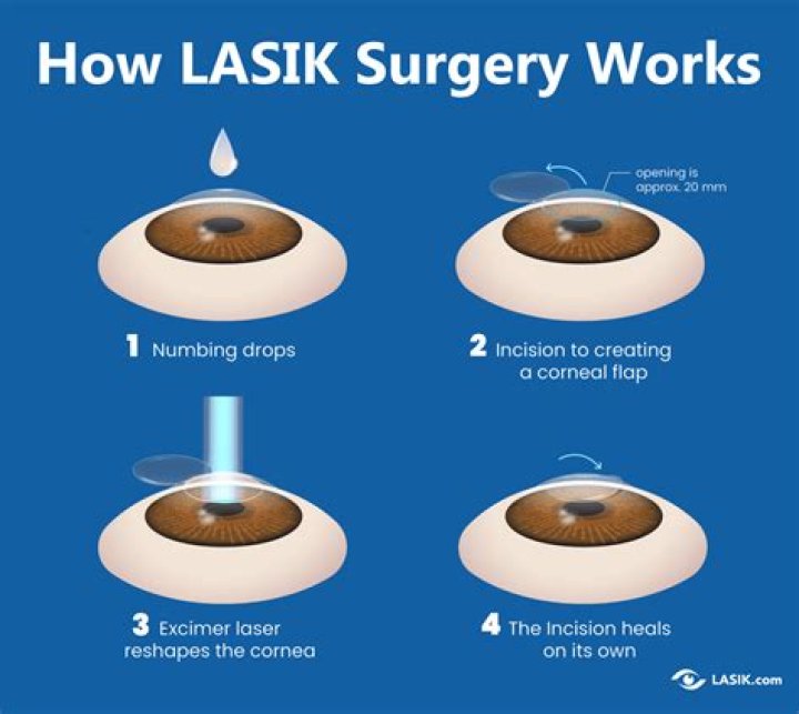 Can I do LASIK at 18?