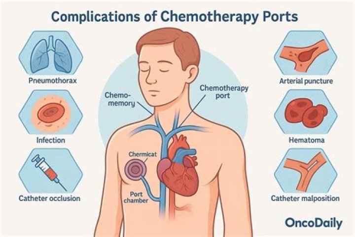 Can I drive after chemo port placement?