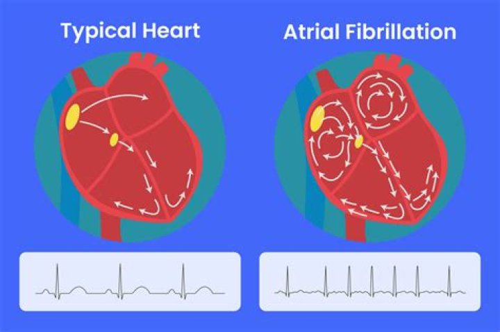 Can I drive if I have atrial fibrillation?