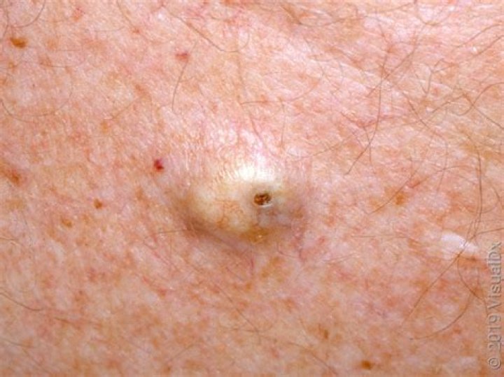 Can I stick a needle in a sebaceous cyst?