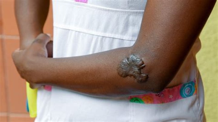 Can keloids go away naturally?