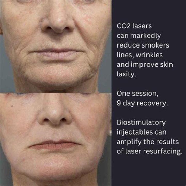 Can laser reduce wrinkles?