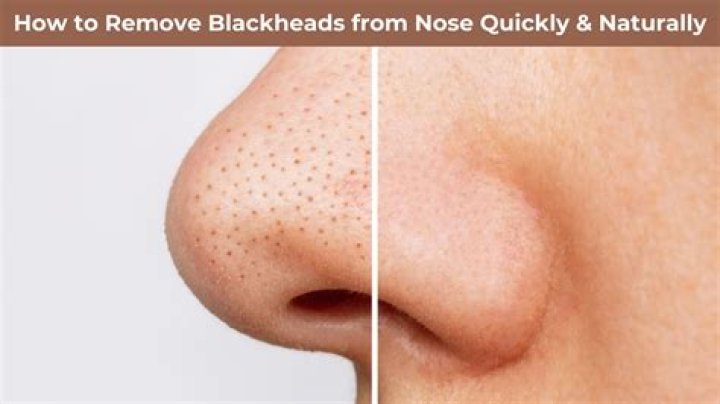 Can laser remove blackheads?