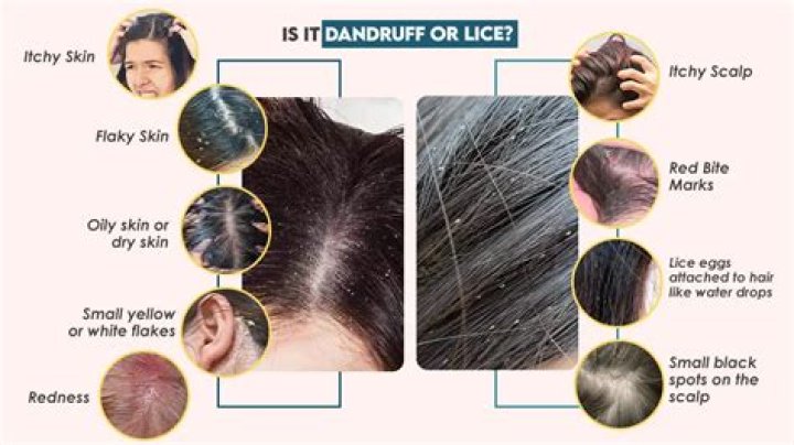 Can lice live in braids?