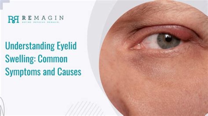 Can liver problems cause eye swelling?