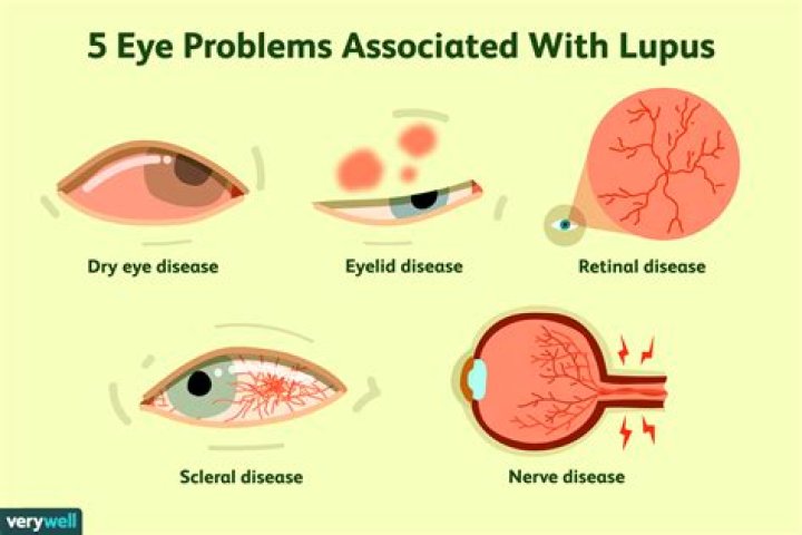 Can lupus affect your eyes?