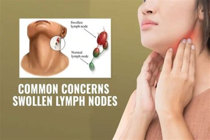 Can lymph glands swell for no reason?