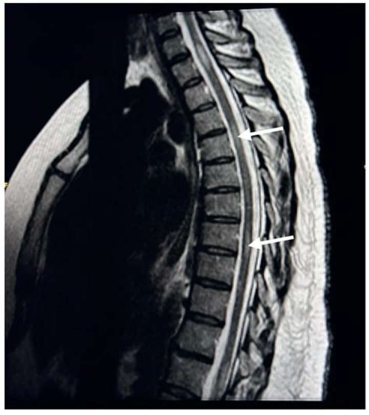 Can MS lesions heal?