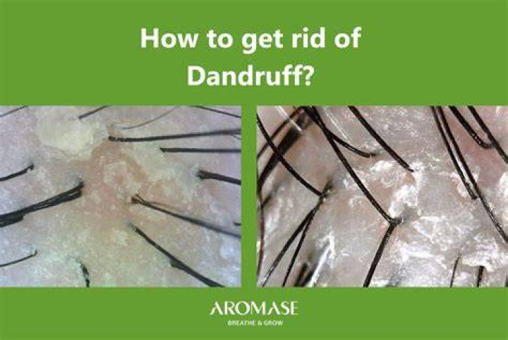 Can onion remove dandruff?