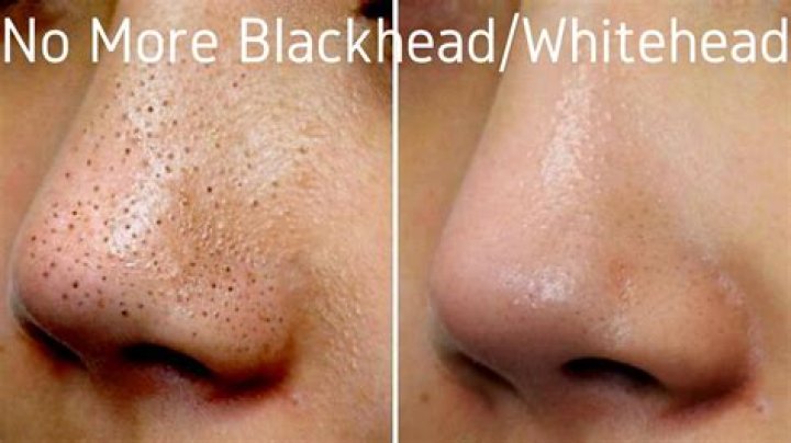 Can salt remove blackheads?