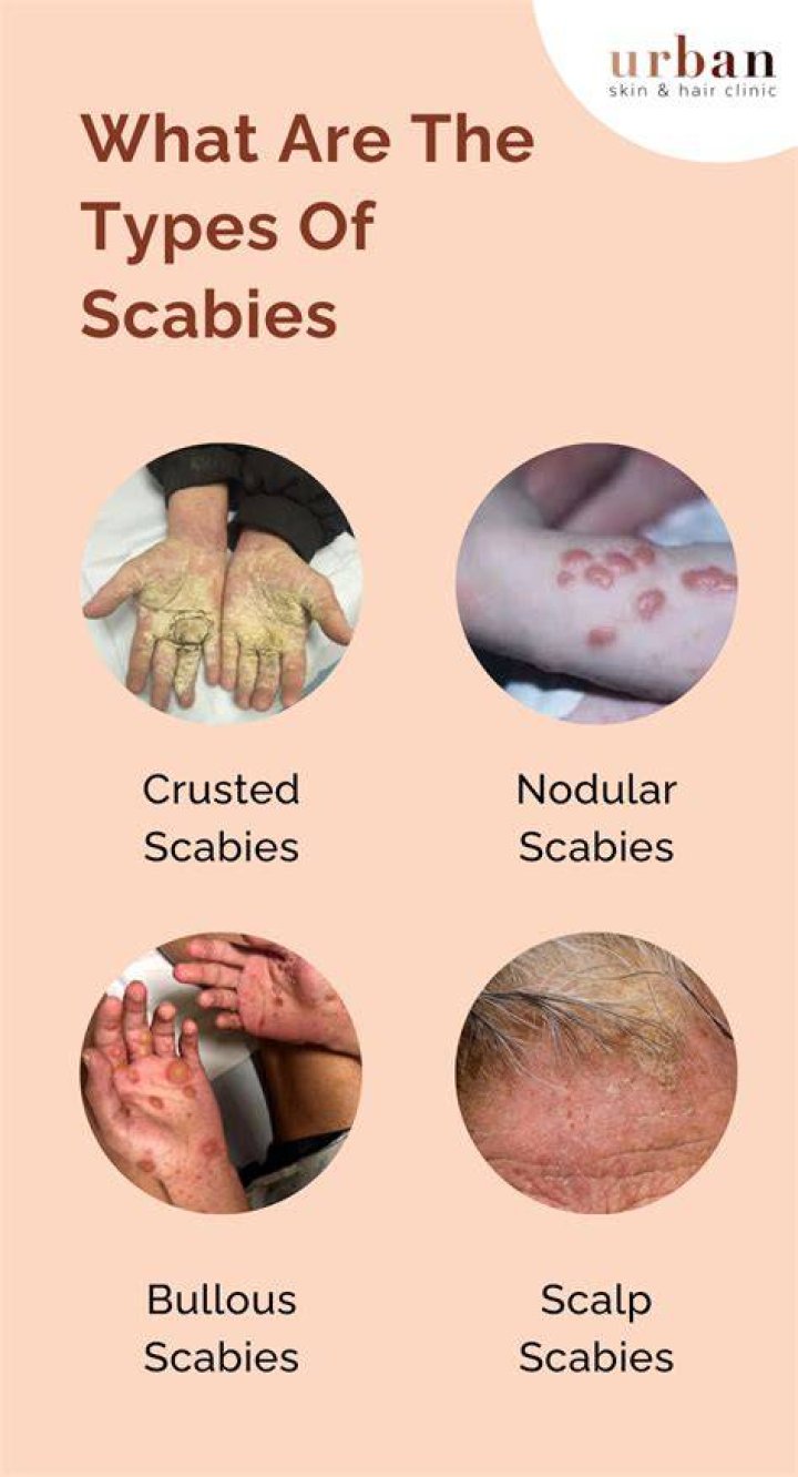 Can scabies go into your vagina?