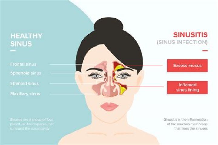 Can sinus infection feel like the flu?