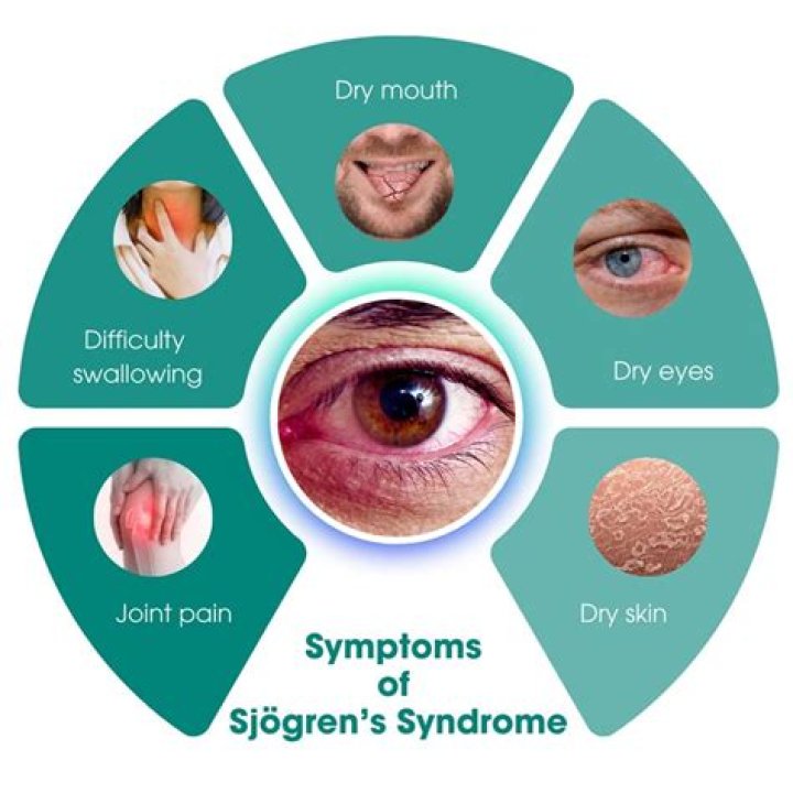 Can sjogrens cause extreme fatigue?