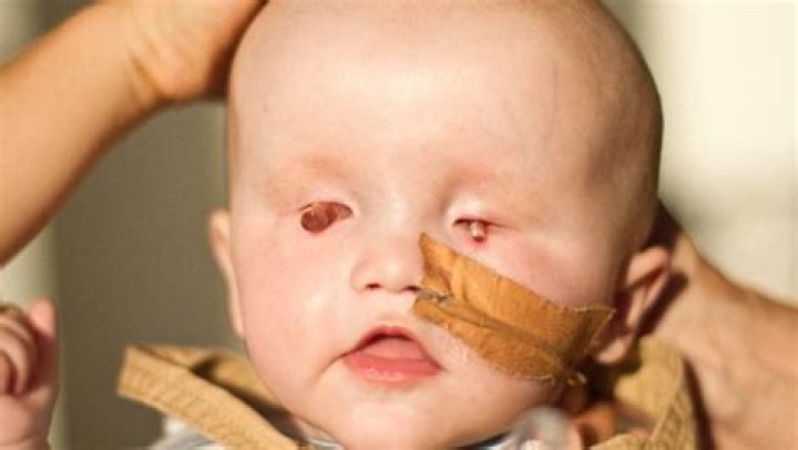 Can someone be born without an eye?