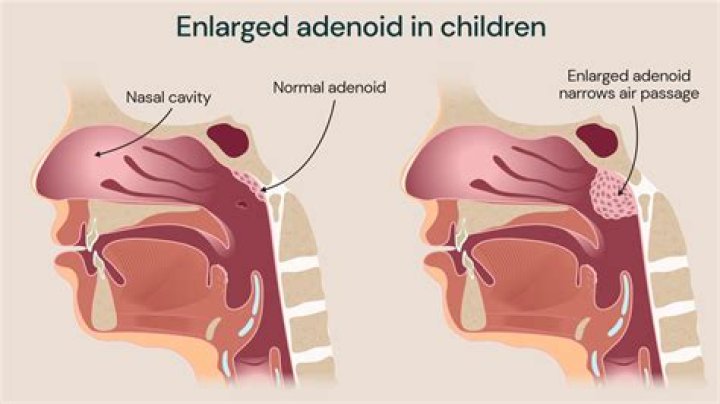 Can tonsils affect hearing?
