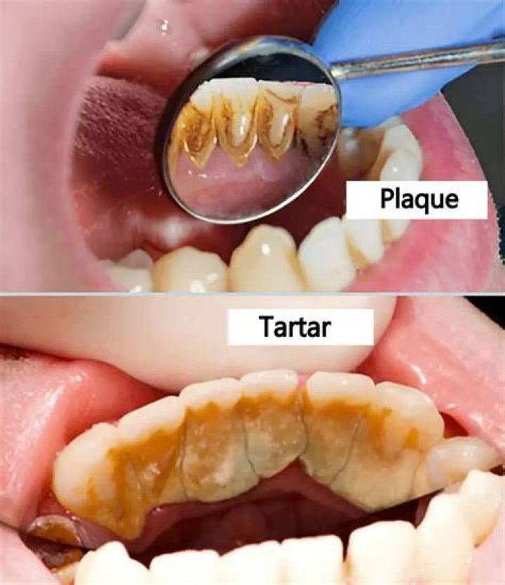 Can turmeric remove tartar?