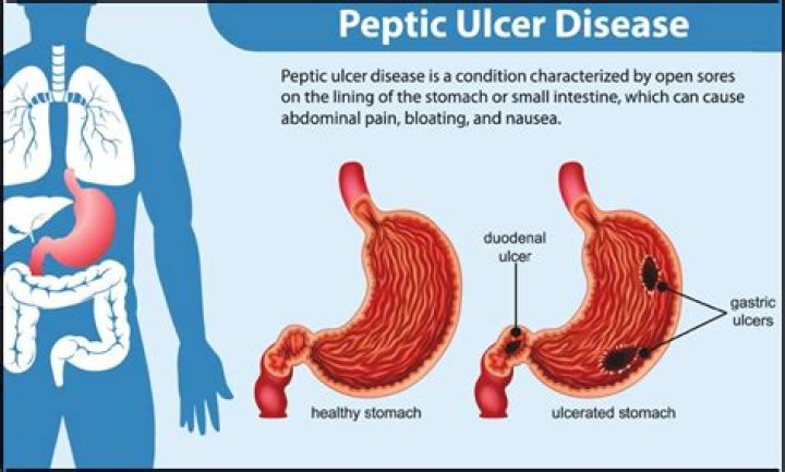 Can ulcer pain last for weeks?