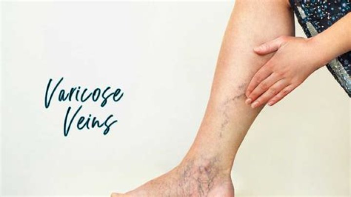Can varicose veins go back to normal?