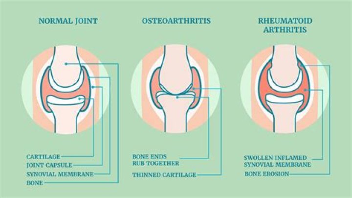 Can vitamin D reverse rheumatoid arthritis?