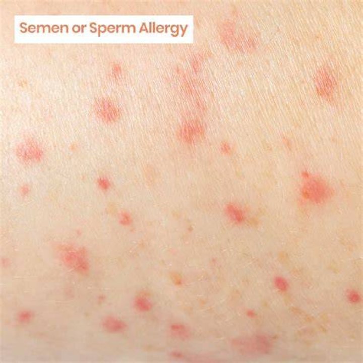 Can you be allergic to sperm?