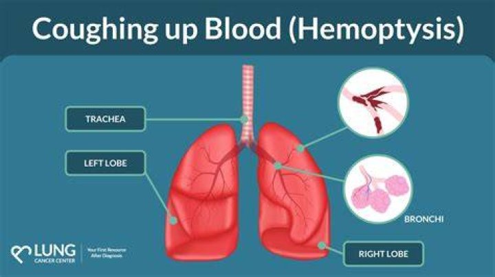 Can you cough up lung tissue?