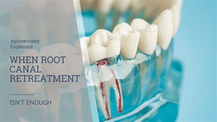 Can you cure a root canal naturally?