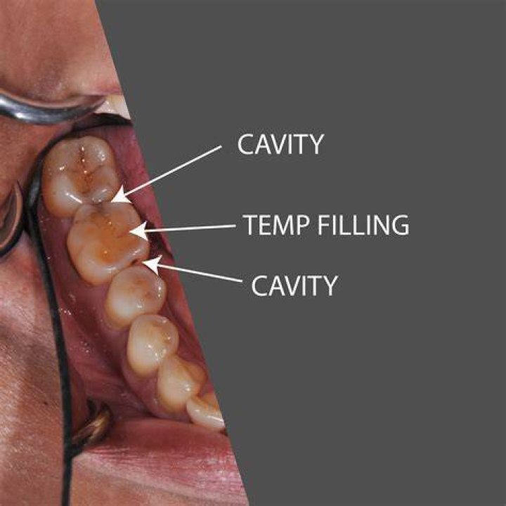 Can you do a temporary filling yourself?