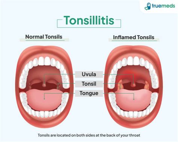 Can you drain a swollen tonsil?